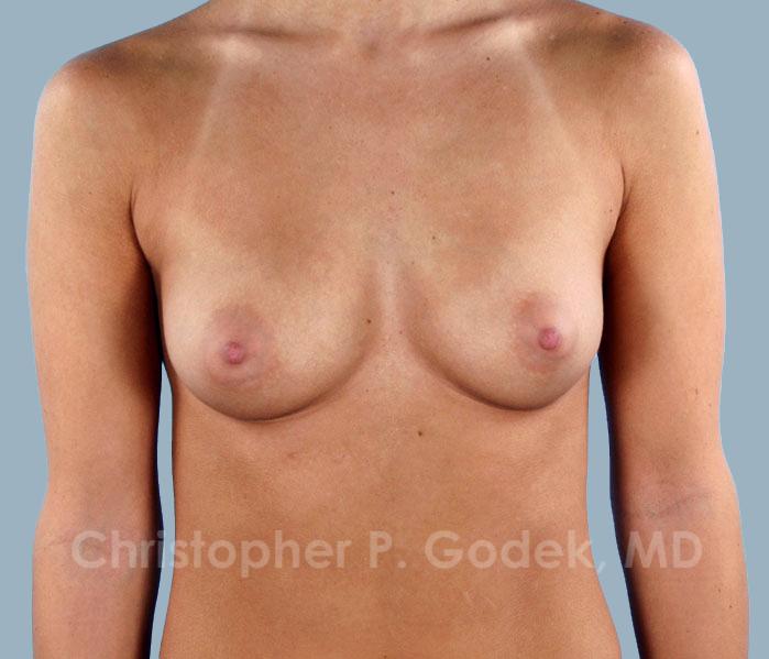 Breast Augmentation  Before & After Image