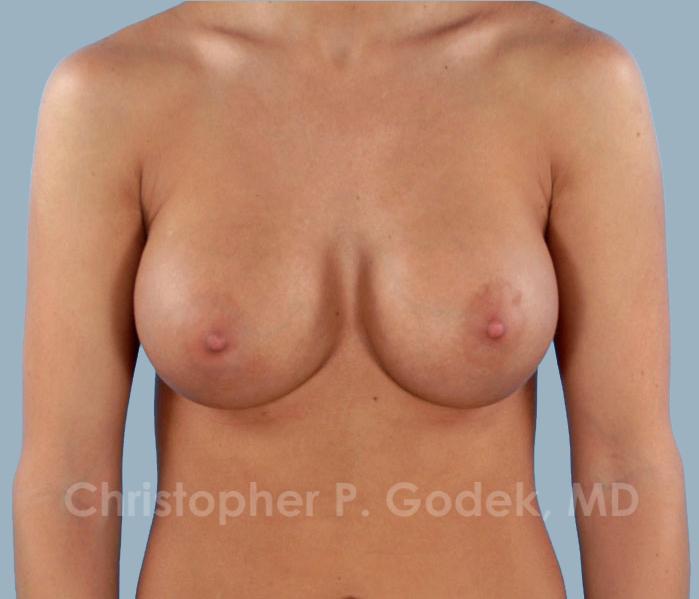 Breast Augmentation  Before & After Image