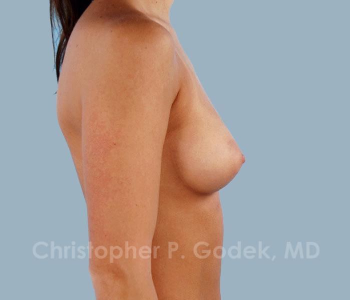 Breast Augmentation  Before & After Image