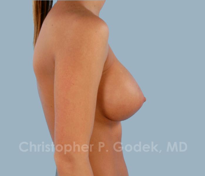 Breast Augmentation  Before & After Image