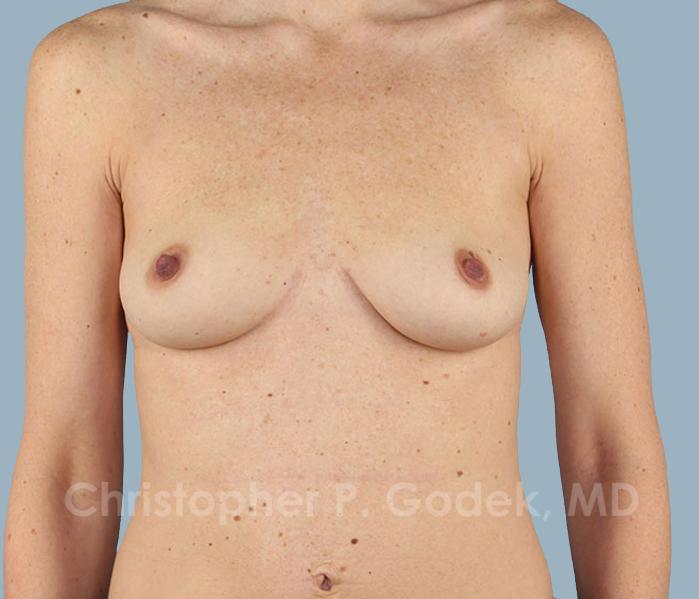 Breast Augmentation  Before & After Image