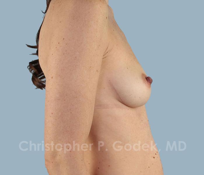 Breast Augmentation  Before & After Image