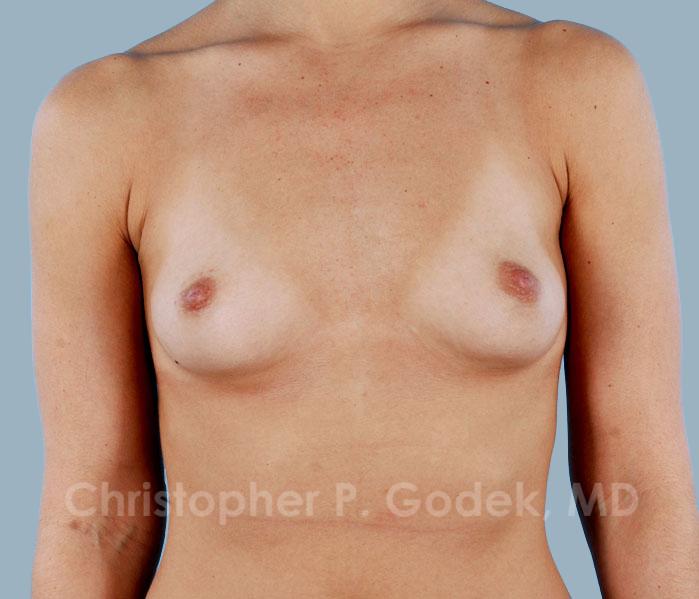 Breast Augmentation  Before & After Image