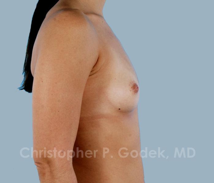 Breast Augmentation  Before & After Image