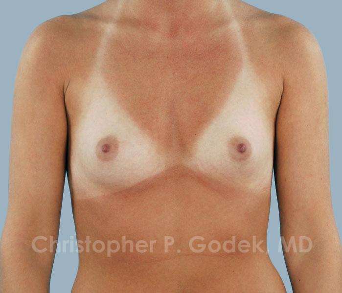 Breast Augmentation  Before & After Image