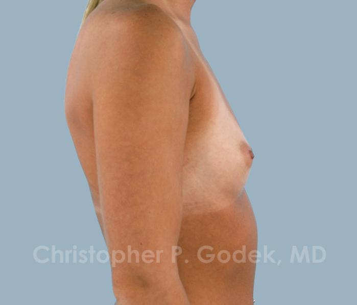 Breast Augmentation  Before & After Image