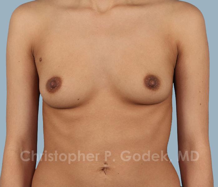 Breast Augmentation  Before & After Image