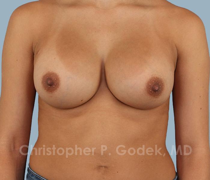 Breast Augmentation  Before & After Image