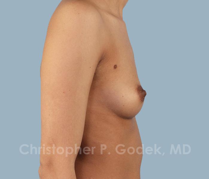 Breast Augmentation  Before & After Image