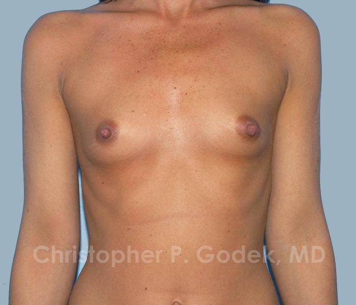 Breast Augmentation  Before & After Image