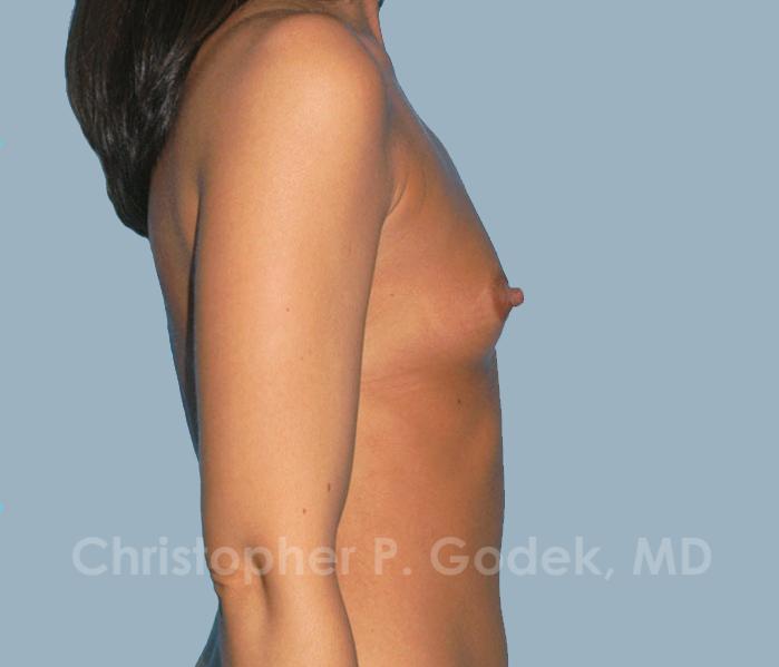 Breast Augmentation  Before & After Image