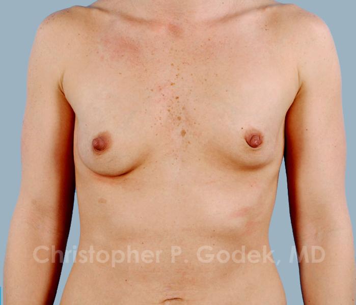 Breast Augmentation  Before & After Image