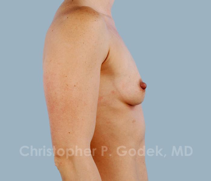 Breast Augmentation  Before & After Image