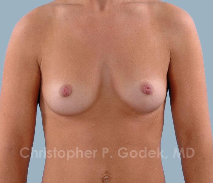 Breast Augmentation  Before & After Image