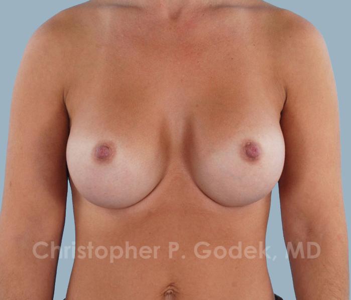 Breast Augmentation  Before & After Image