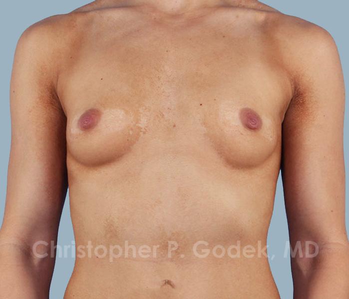 Breast Augmentation  Before & After Image