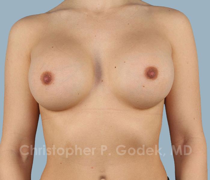 Breast Augmentation  Before & After Image