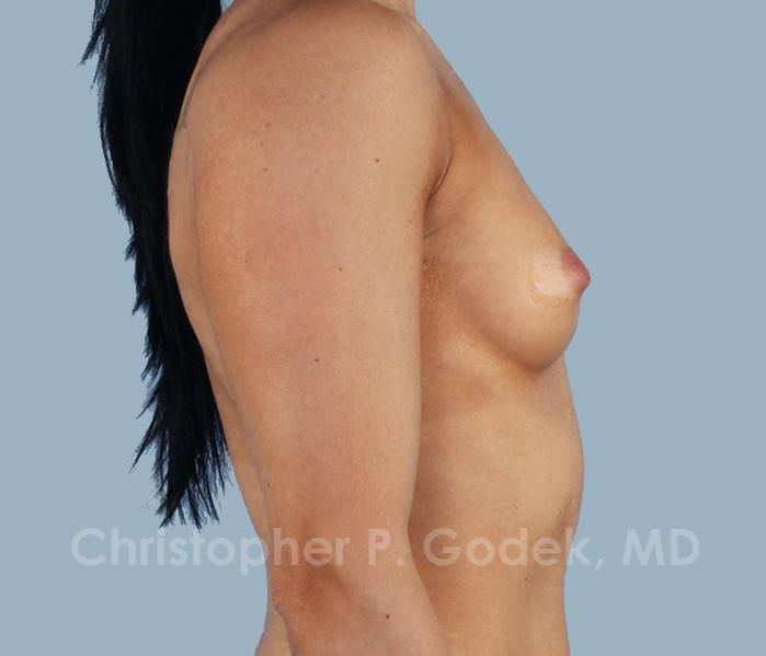 Breast Augmentation  Before & After Image