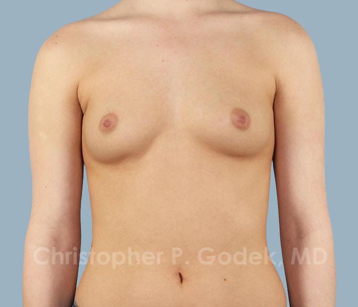 Breast Augmentation  Before & After Image