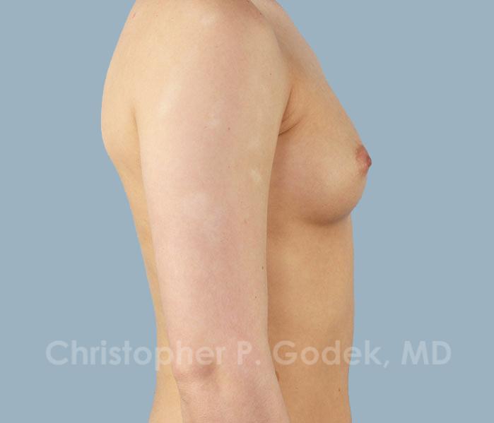 Breast Augmentation  Before & After Image