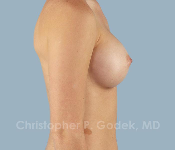 Breast Augmentation  Before & After Image