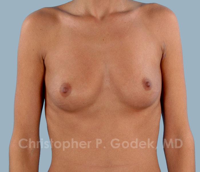 Breast Augmentation  Before & After Image