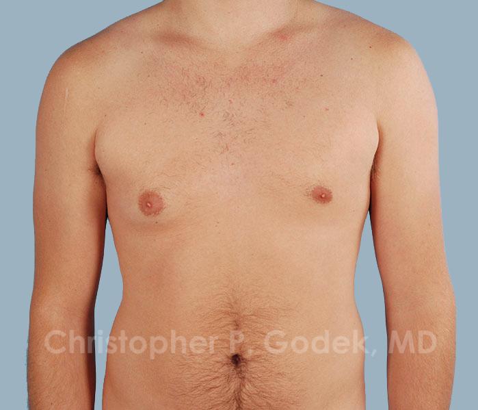 Gynecomastia Before & After Image