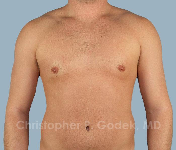 Gynecomastia Before & After Image