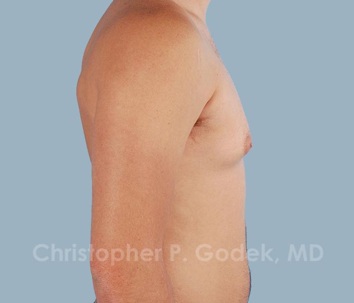 Gynecomastia Before & After Image