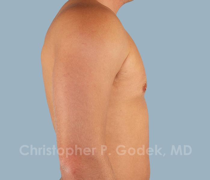 Gynecomastia Before & After Image