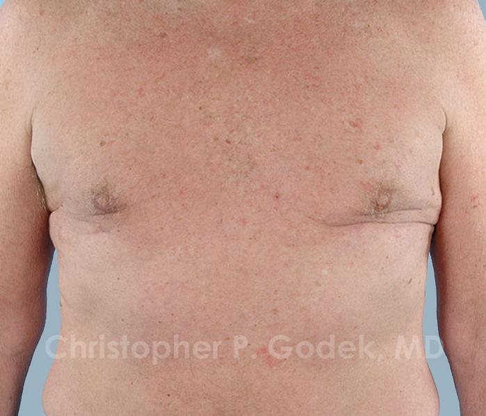 Gynecomastia Before & After Image