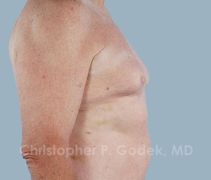 Gynecomastia Before & After Image