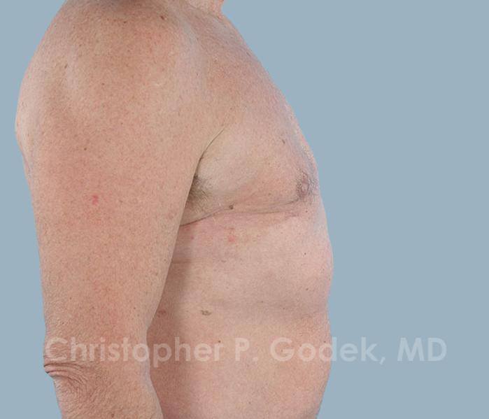 Gynecomastia Before & After Image