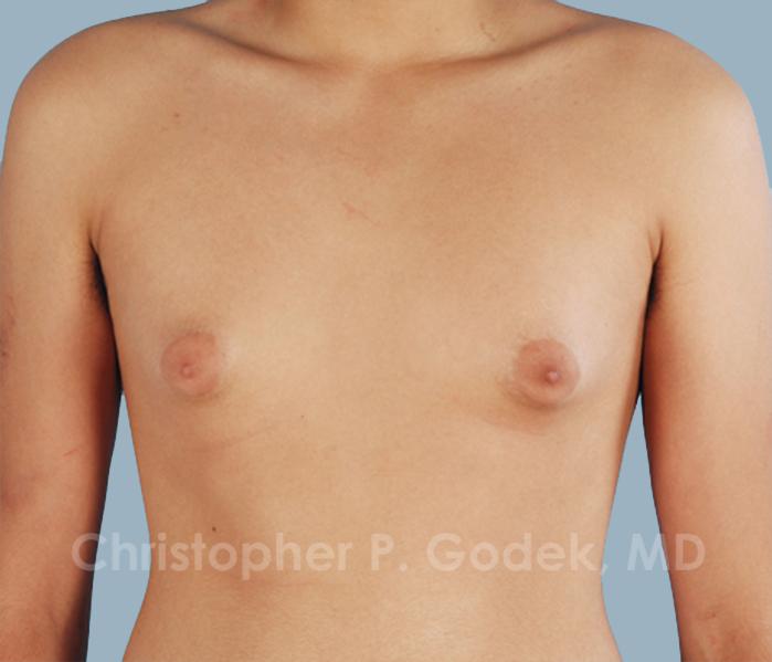 Gynecomastia Before & After Image