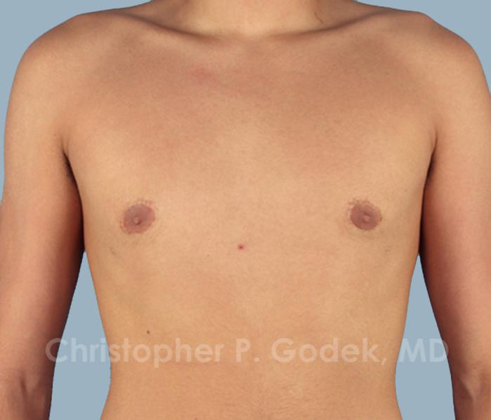 Gynecomastia Before & After Image