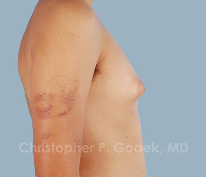 Gynecomastia Before & After Image