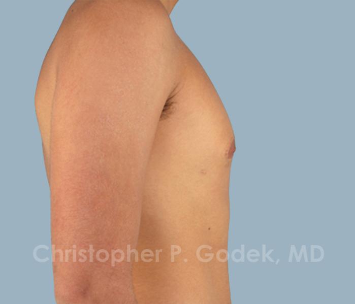 Gynecomastia Before & After Image