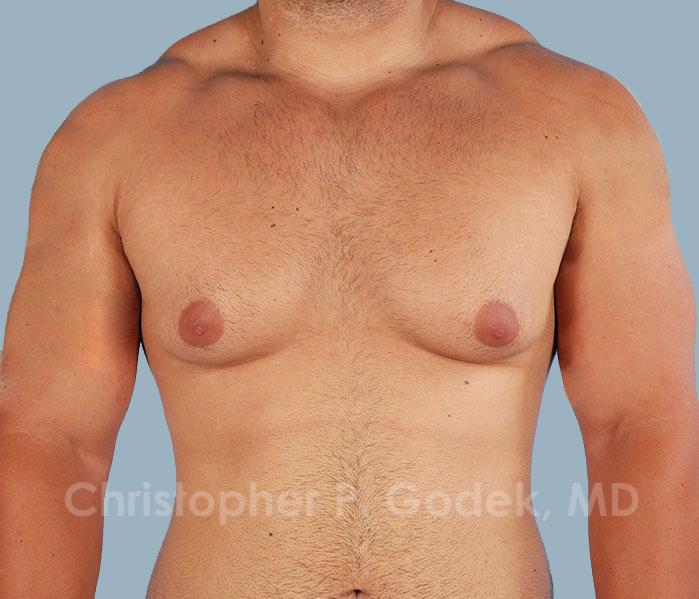 Gynecomastia Before & After Image