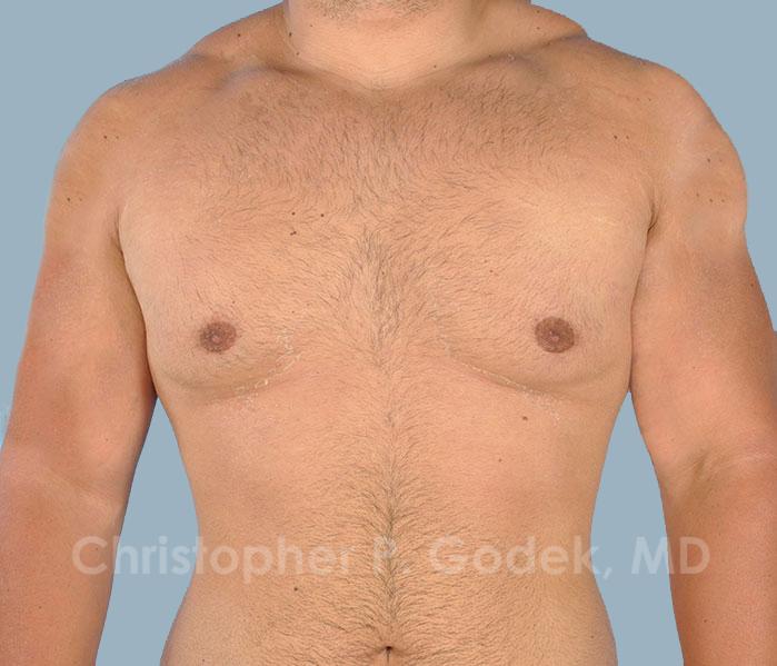 Gynecomastia Before & After Image