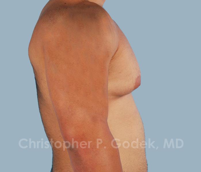 Gynecomastia Before & After Image