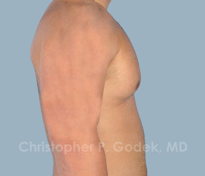 Gynecomastia Before & After Image