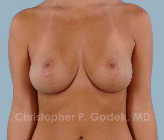 Breast Lift  Before & After Image