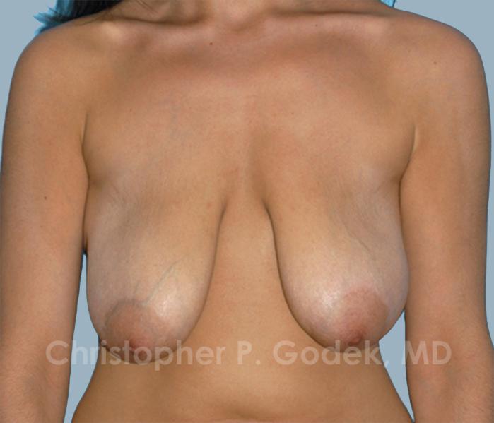 Breast Lift  Before & After Image