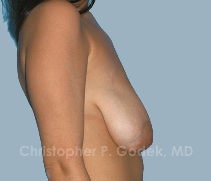 Breast Lift  Before & After Image