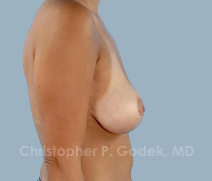 Breast Lift  Before & After Image