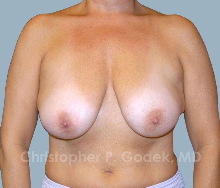 Breast Lift  Before & After Image