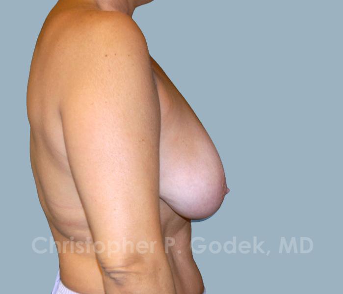 Breast Lift  Before & After Image