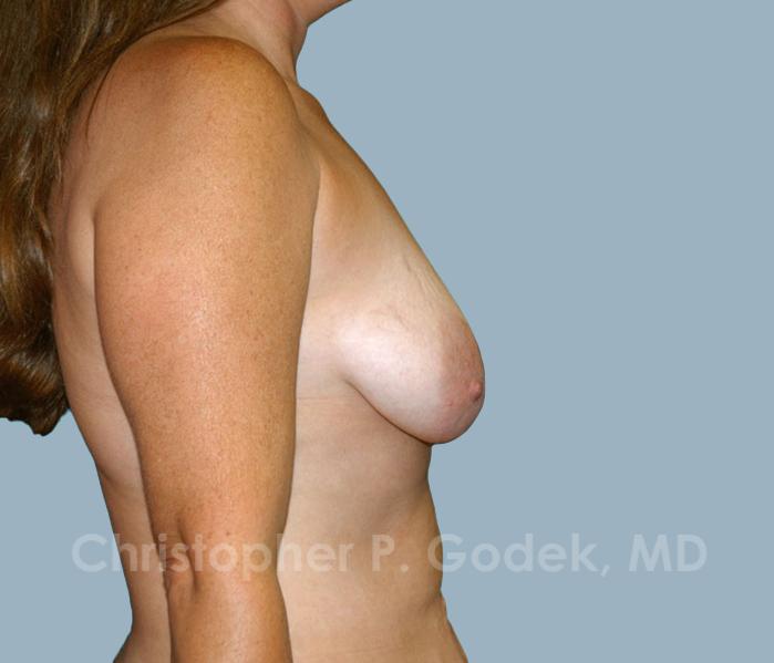 Breast Lift  Before & After Image