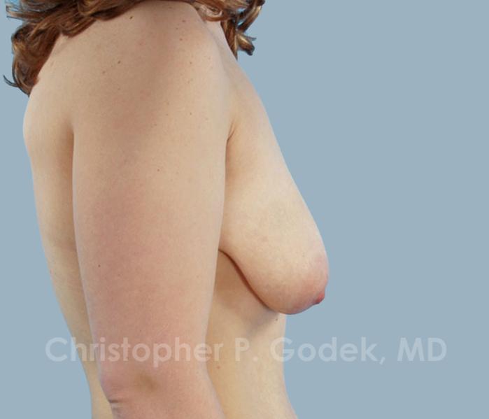 Breast Lift  Before & After Image