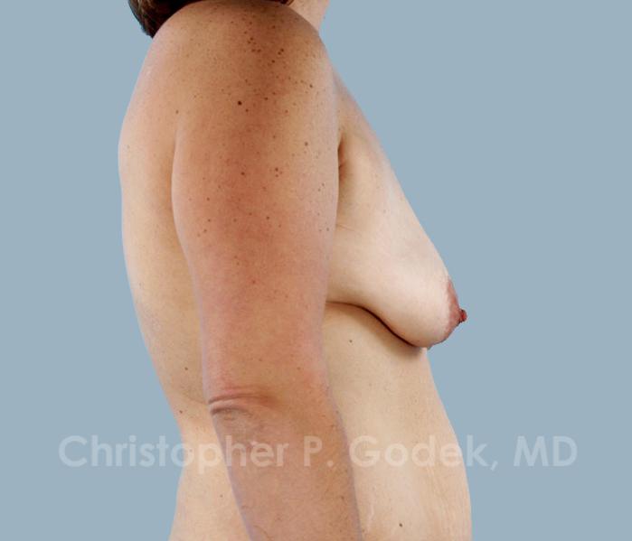 Breast Lift  Before & After Image